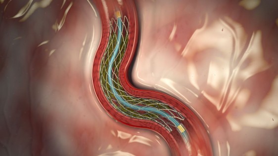 Arteria con un sistema stent 