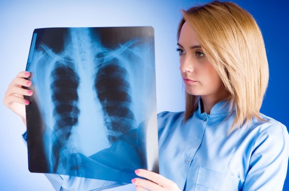Entre el 80 y el 85 por ciento de los casos con cáncer pulmonar, se detectan en etapas avanzadas y suelen ser confundidos con otras patologías