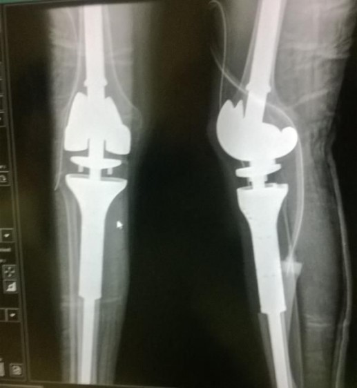 Placa de Rayos X con dos piernas y el implante