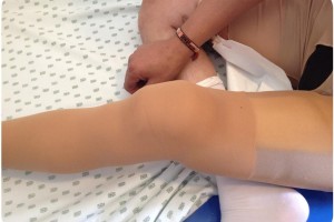 Acercamiento de la prótesis en el cuerpo del paciente