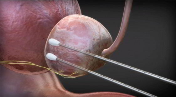Ilustración 3D prostata con dos instrumentos alargados en su interior