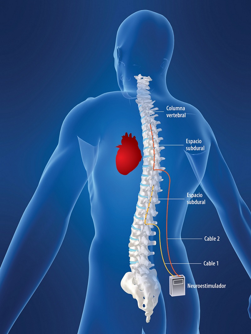Reducción en arritmias, dolor de pecho y fatiga son algunos de los principales beneficios observados en la aplicación del “estimulador de espina dorsal”.
