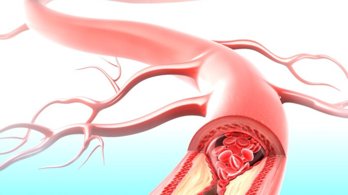 Arteria bloqueándose por depósitos de colesterol