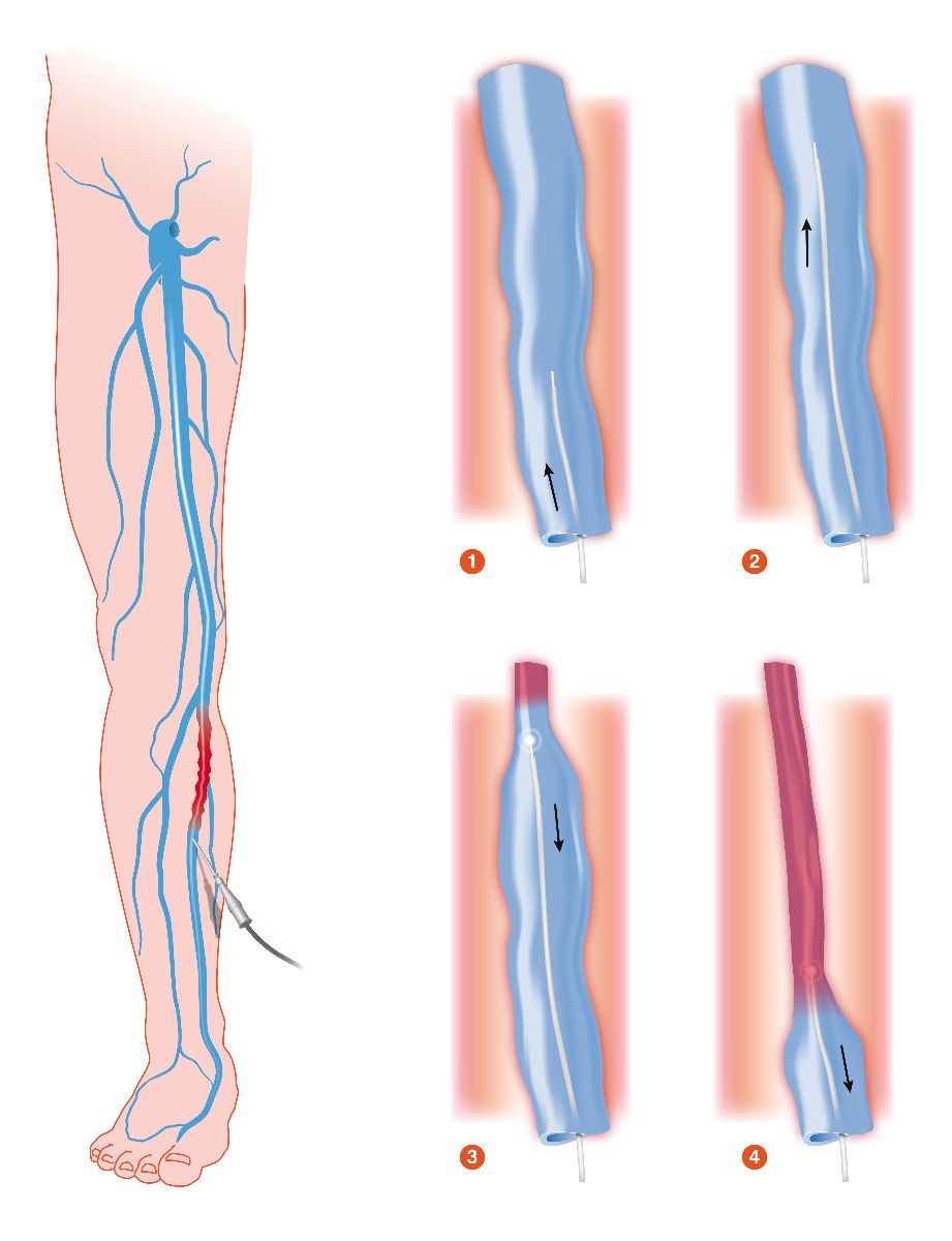 Ilustración de venosas varicosas