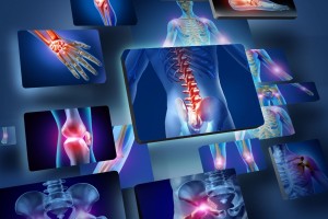 Ilustracines de daños por osteoporosis