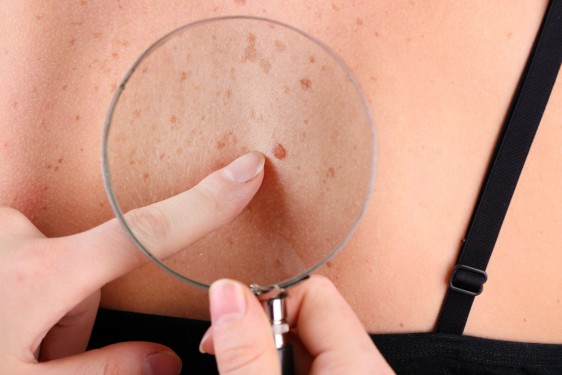 Mujer realiza una inspección de la piel con una lupa