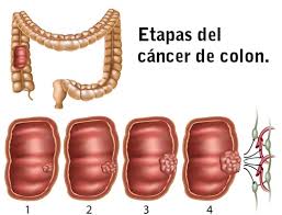Ilustración del cáncer de colon