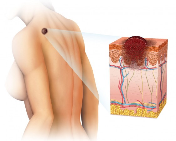 Ilustración de una piel con una mancha y un corte de piel de como afecta el cáncer de piel