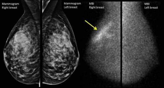Imagen de una mamografía  al lado de una imágenes molecular
