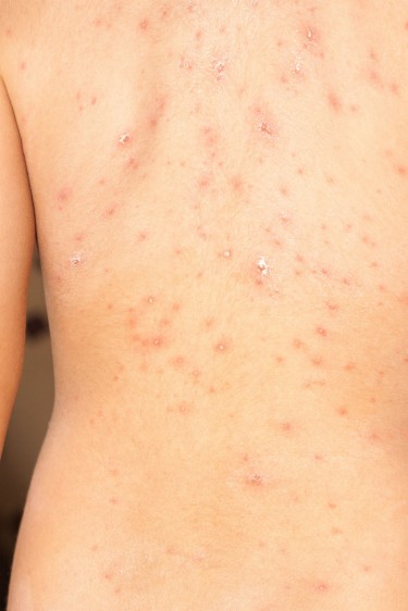 El herpes zoster puede confundirse con varicela, mejor acude con un especialista.