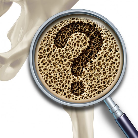 Se estima que aproximadamente 10% de la población mundial mayor de 60 años presentan problemas clínicos que podrían atribuirse a la osteoartrosis.<sup><a href="#referencia-2"  data-rid="ref-2"> 2 </a></sup>