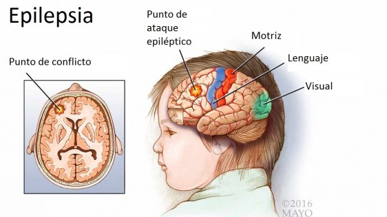 Ilustración médica de un cerebro con epilepsia