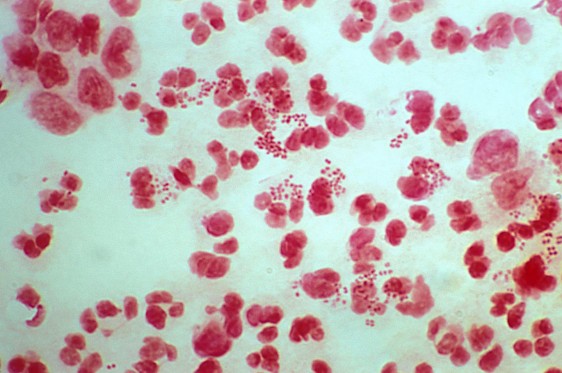 La infección es causada por la bacteria Neisseria gonorrhoeae 