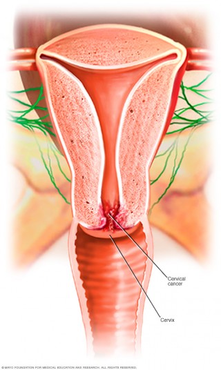 El cáncer de cuello uterino se produce en las células del cuello del útero (la parte baja que se conecta con la vagina).
