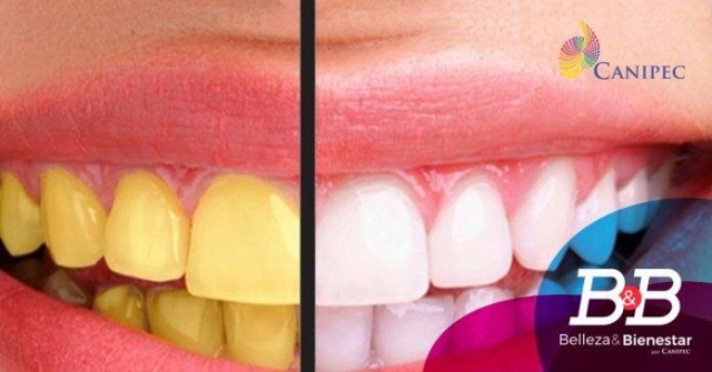 Mantener una mejor higiene bucal te permitirá disminuir el pigmento de tus dientes y alcanzar una mejor sonrisa.