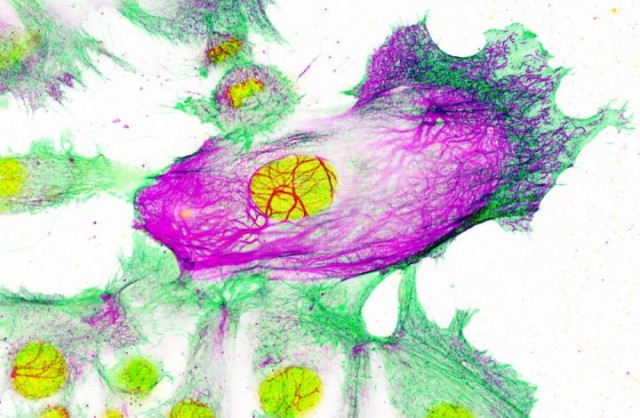 Células de cáncer de mama resistentes a los medicamentos rodeadas de células no resistentes. El núcleo celular se muestra en amarillo; mientras que el 'andamio' de la celda se muestra en verde y púrpura. La queratina-80 se muestra en púrpura.