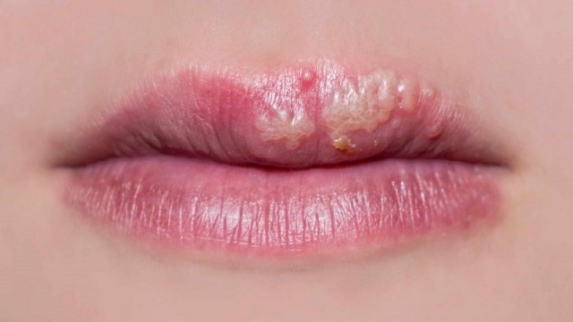 Los niños menores de 5 años pueden tener herpes labial dentro de la boca y las lesiones frecuentemente se confunden con aftas. Las aftas solo afectan la membrana mucosa y no se deben al virus del herpes simple.