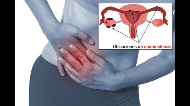 Avances en la investigación de la endometriosis en México