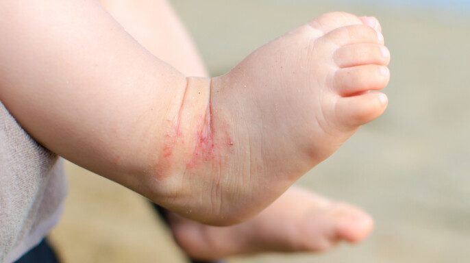 Dermatitis atópica pies recién nacidos eczema