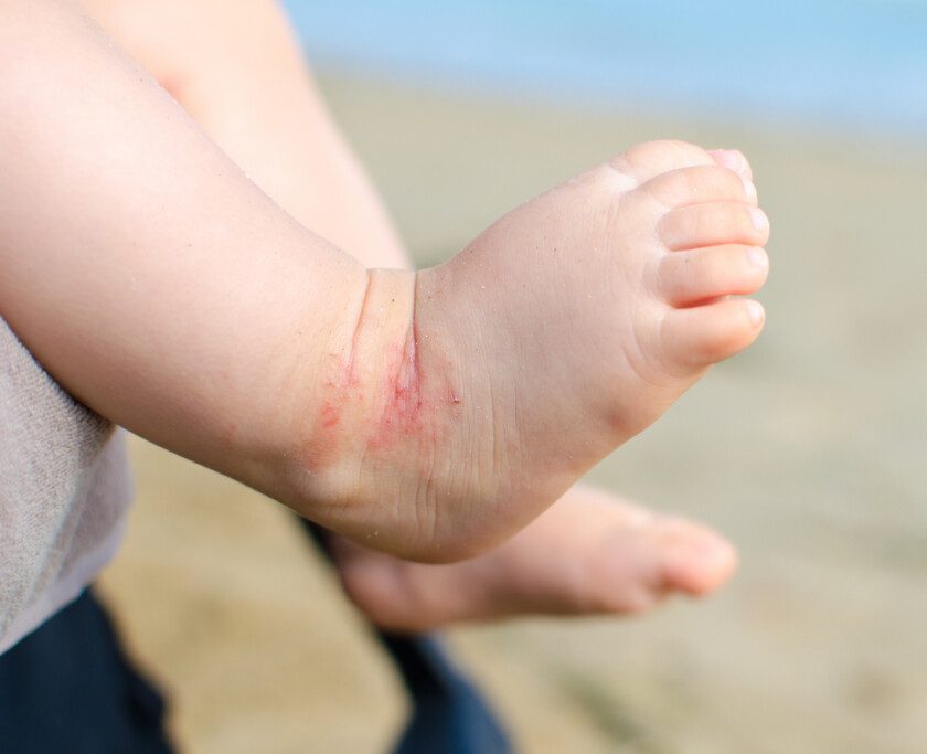 Dermatitis atópica niños, se expresa de distintas formas la edad - Plenilunia