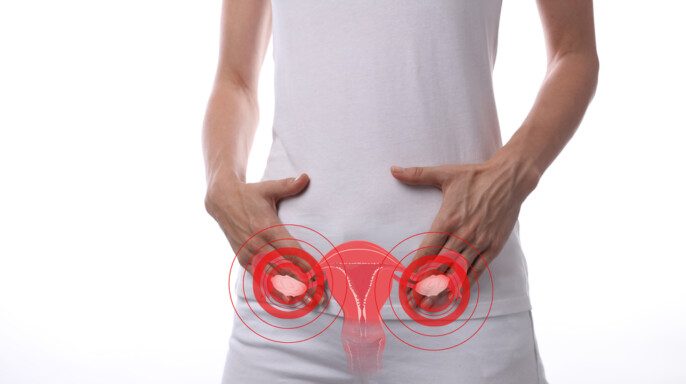 Síndrome de ovario poliquístico. Ginecología