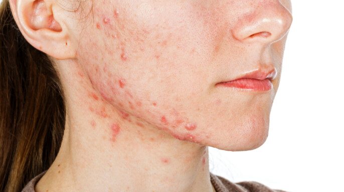 Lesiones de acné en mujer adulta