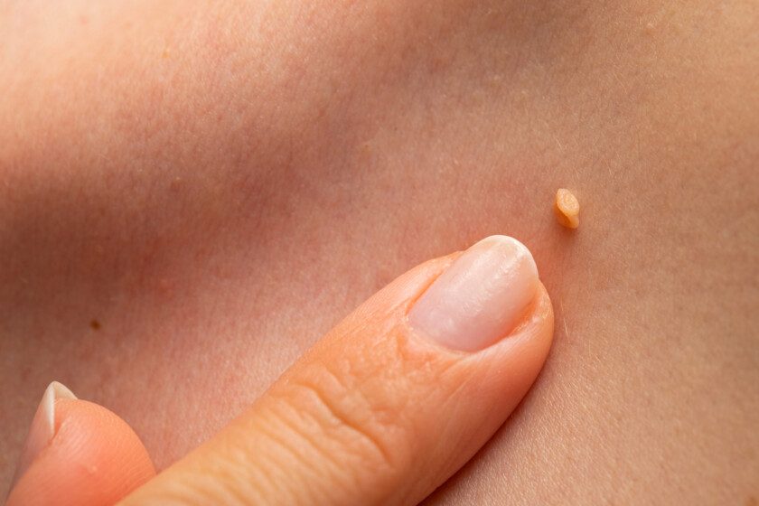 Papiloma en la piel humana — Foto de Stock Papiloma en la piel humana.