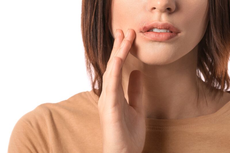 Mujer joven con herpes labial sobre fondo blanco