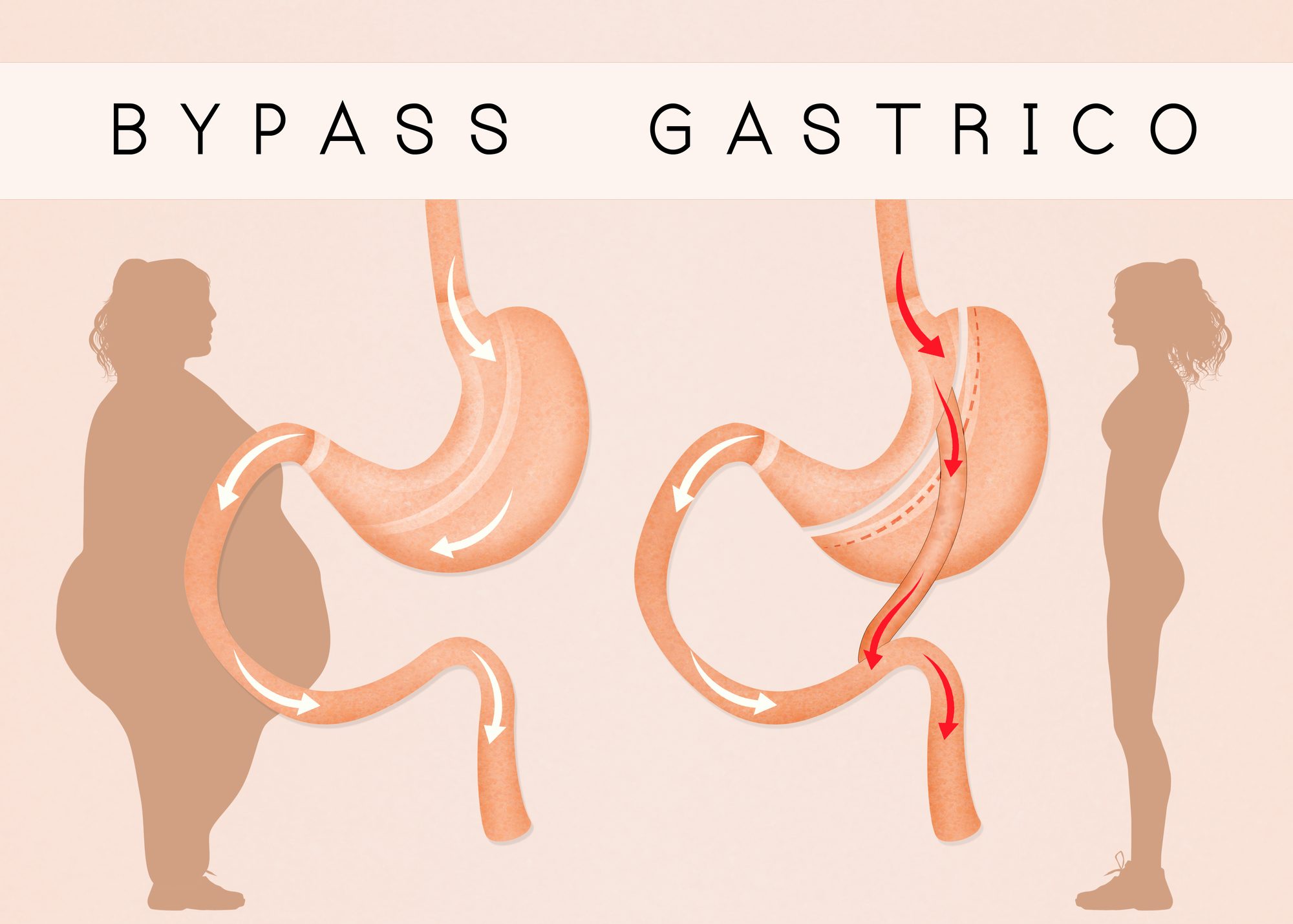 Bypass Gástrico