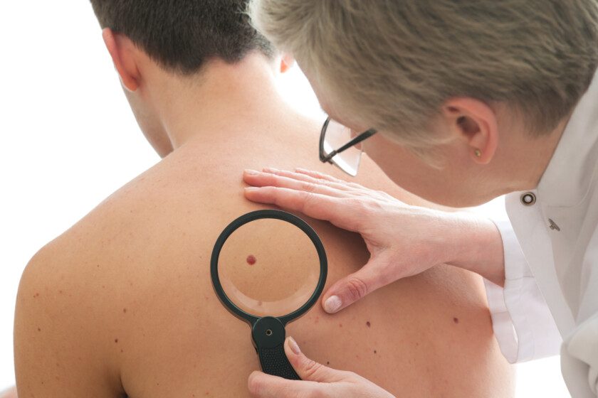 Las opciones terapéuticas para cáncer de piel permiten vislumbrar una posible cura a futuro.