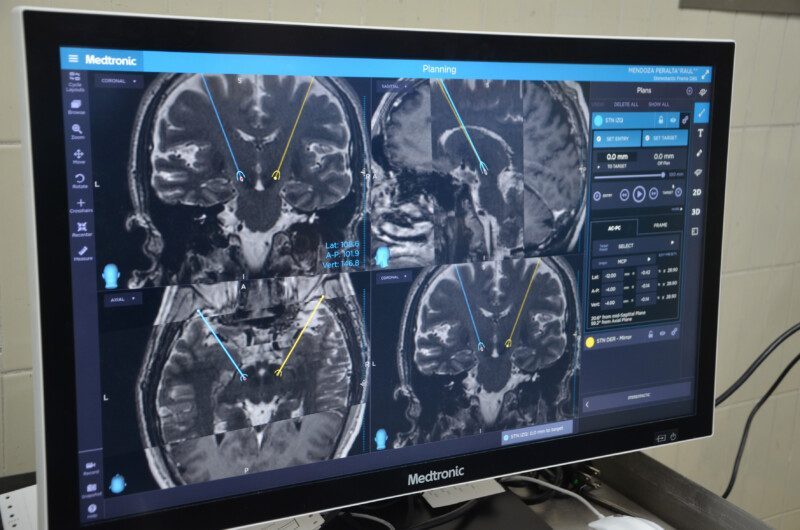 Pruebas de detección Enfermedad del Parkinson