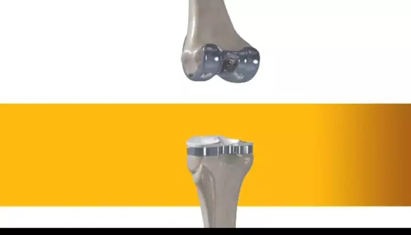 Modelo 3D de tecnologia para cirugias de reemplazo articular de rodilla