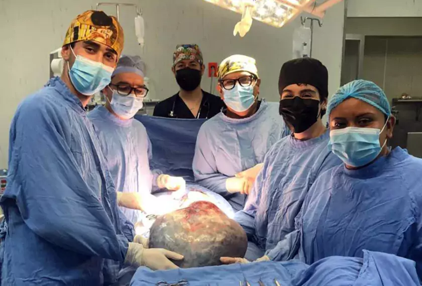 Cirugía para retirar tumor ovárico de 21 kilogramos