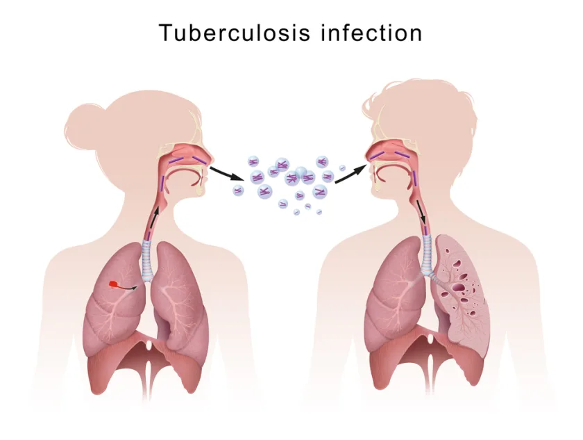 La tuberculosis es la principal causa de muerte en el mundo.